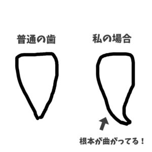 歯の根元曲がってる
