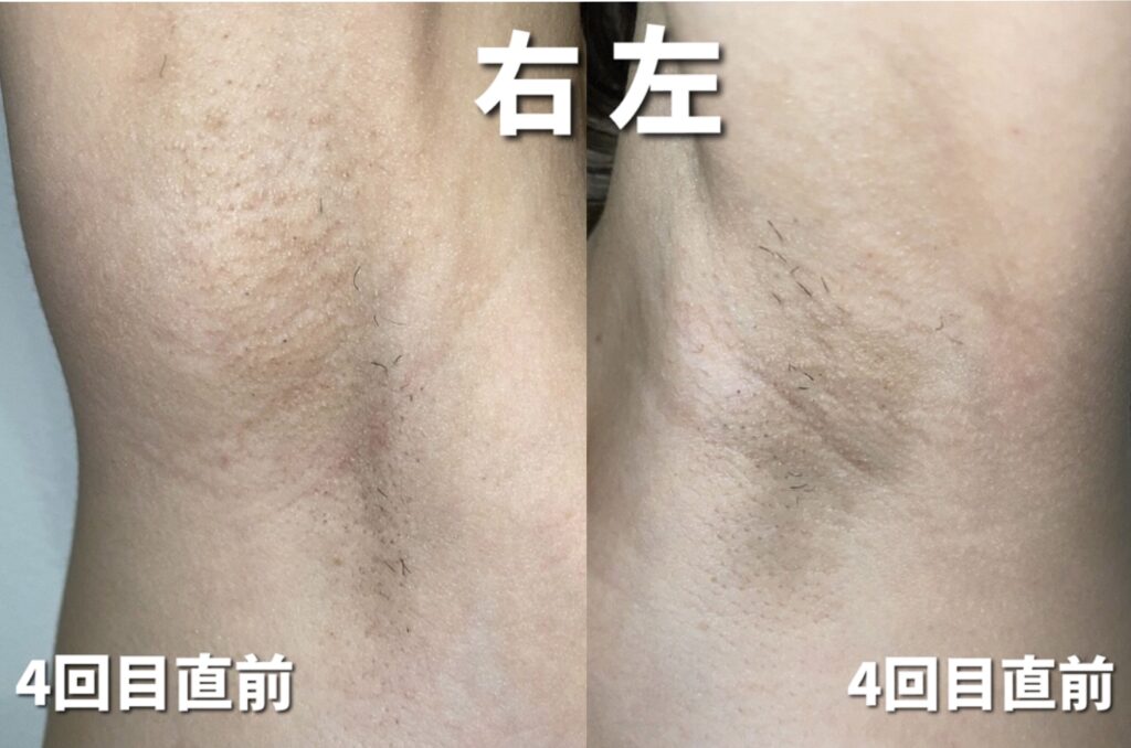 ケノン脱毛4回目直前