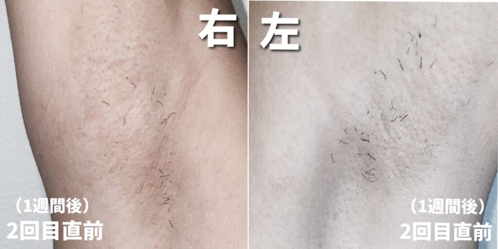 ケノン脱毛2回目直前