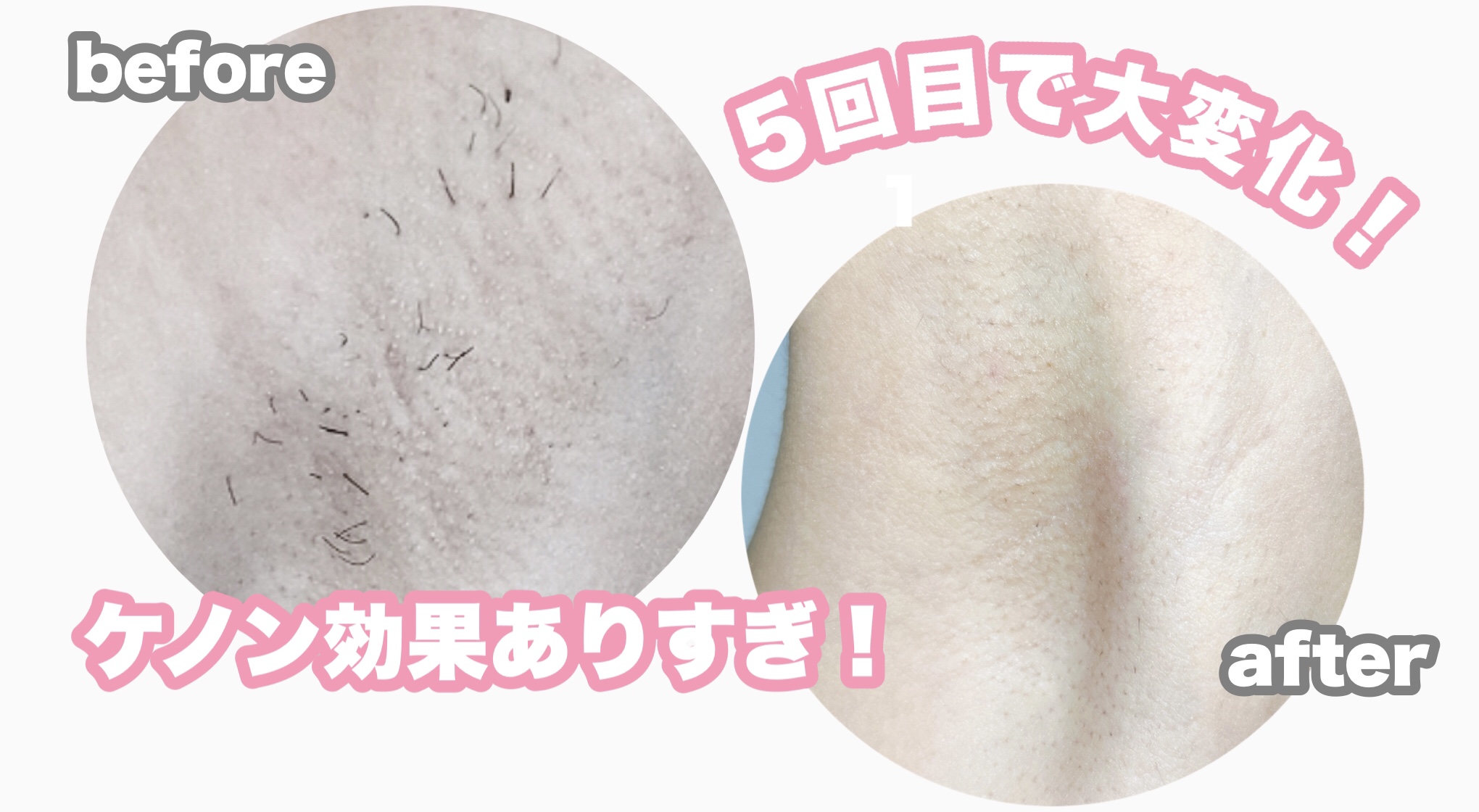 ケノン経過画像