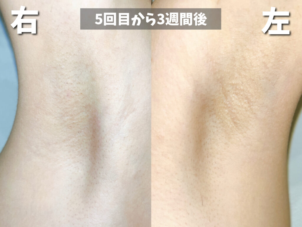 ケノン経過