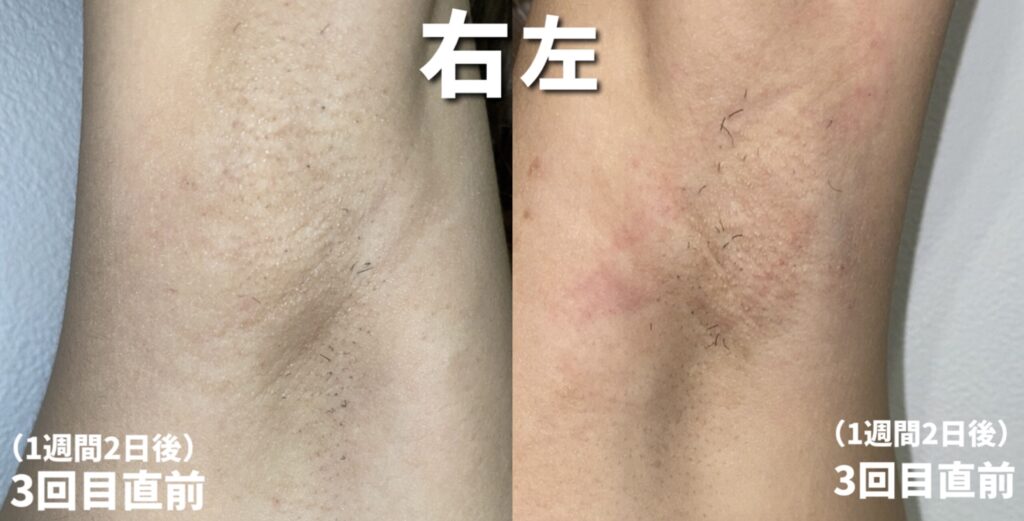 ケノン脱毛3回目直前