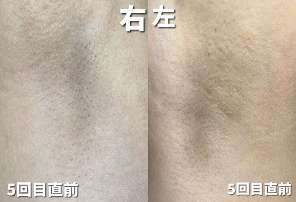 ケノン脱毛5回目直前